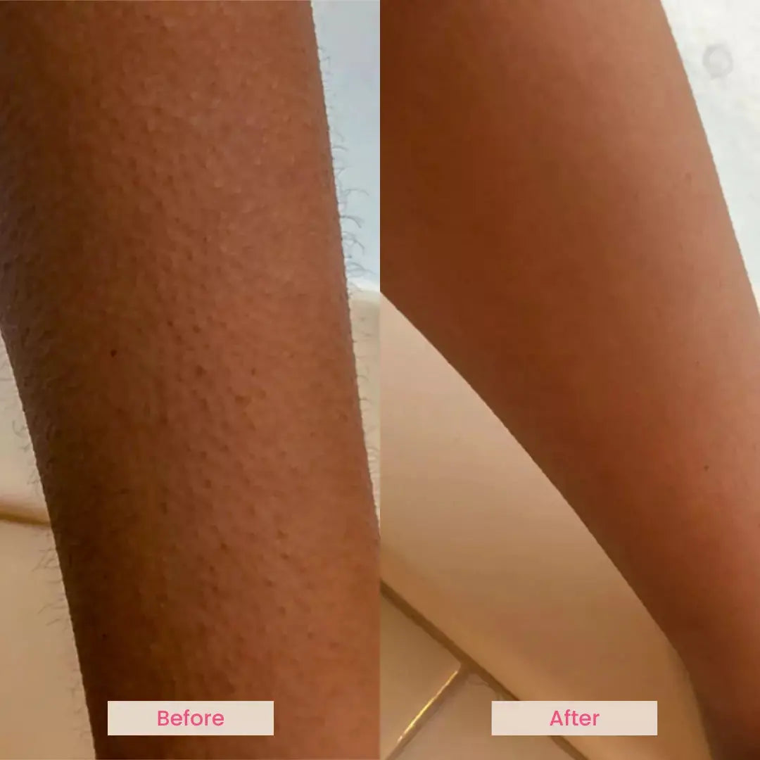 EvenSkyn® Pulsar:At-Home IPL Laser Hair Removal Handset