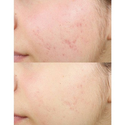 derma e Anti-Acne Oil Control Matte Moisturizer 2oz - New