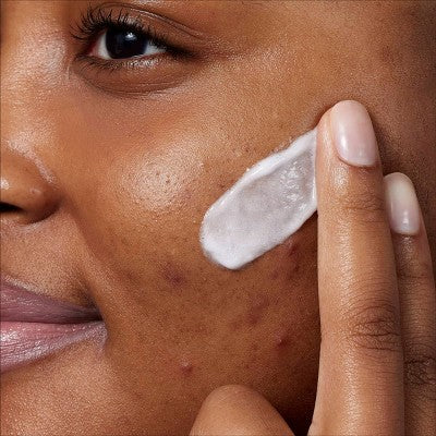 CeraVe Acne Control Foaming Face Cleanser 10% BPO 5 fl oz - Imperfect Box