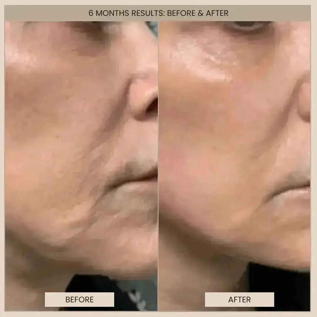 Lumo⁺ + Phoenix: Professional-Grade Skin Tightening and Lifting Duo