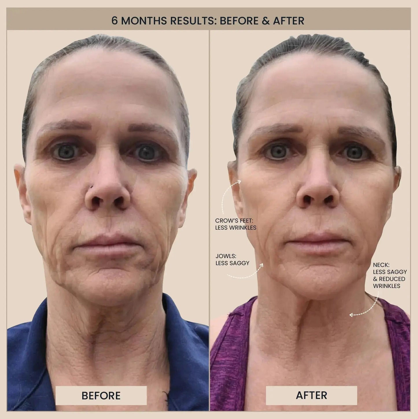 EvenSkyn® Lumo⁺: Premium Anti-Aging & Skin Tightening Handset